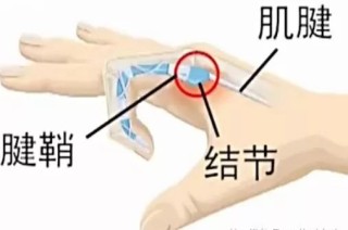 搜狐订阅：4949澳门开奖免费大全-大拇指腱鞘炎怎么治疗