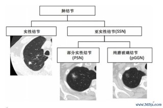 腾讯：马会香港7777788888-双肺结节是什么病