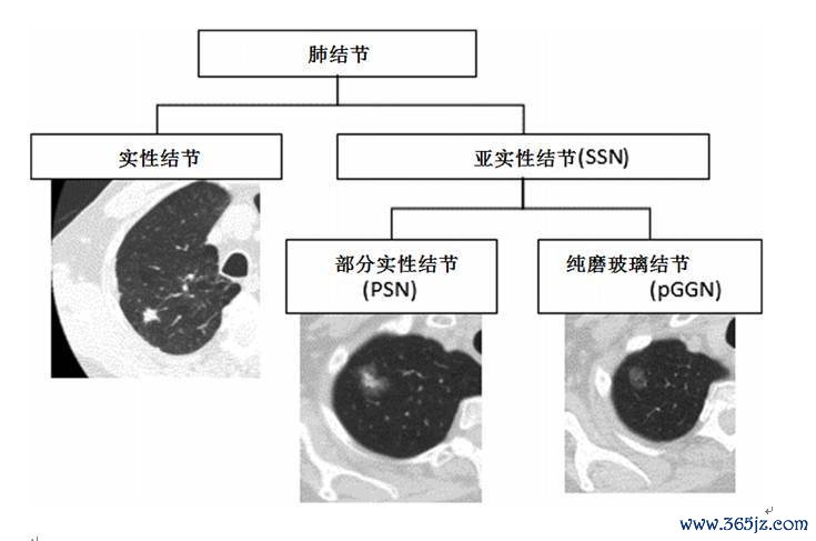 腾讯：马会香港7777788888-双肺结节是什么病  第1张
